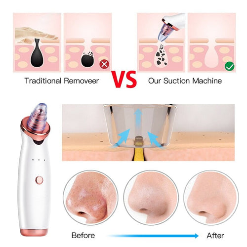 Vacuum Blackhead Remover Pimple Acne Removal Tool Skin Care Pore